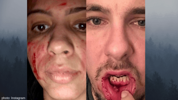 90 Day Fiance: Larissa Dos Santos Lima and Colt Johnson Bloodied Up. 