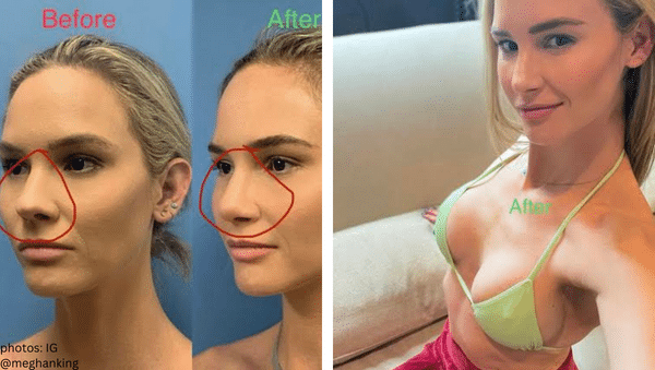 rhoc real housewives of orange county meghan king edmonds new nose new boobs new year plastic surgery