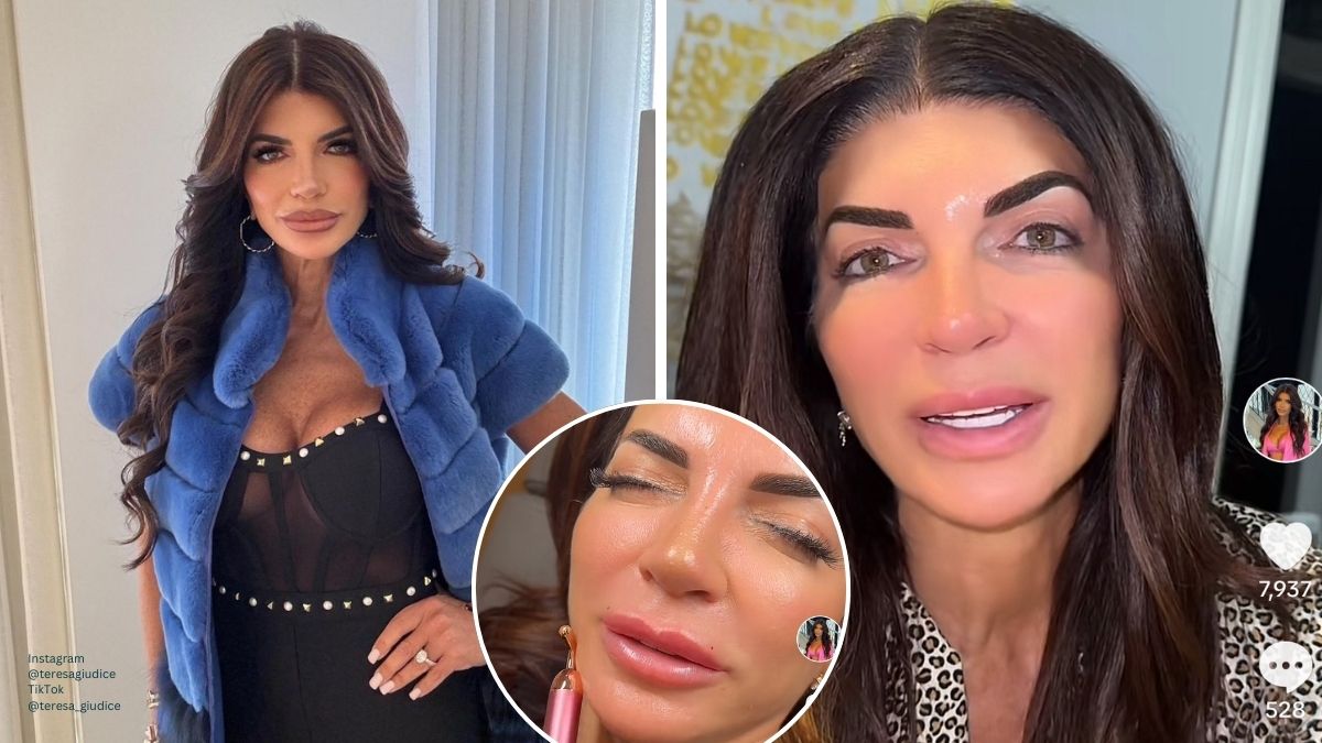 teresa giudice hot dog lips dissolved filler rhonj