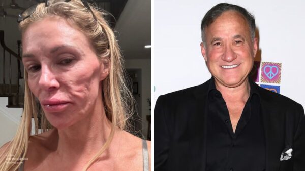 brandi glanville terry dubrow rhobh face