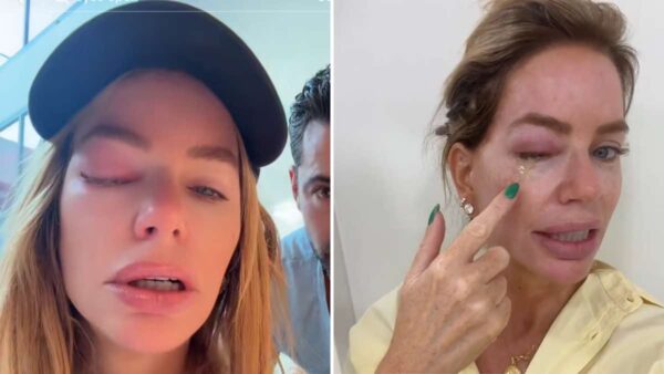 Caroline Stanbury Eye infection