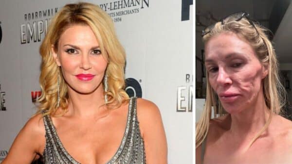 brandi face healing